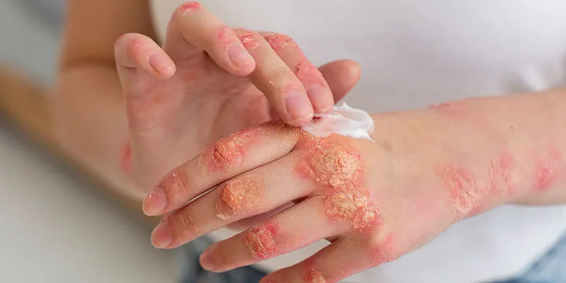 early-treatment-improves-the-quality-of-life-for-psoriasis-patients