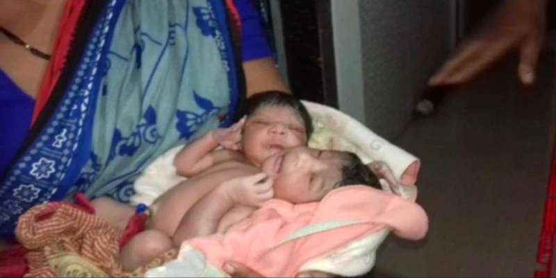 ओडिशा में महिला ने दो सिर और तीन हाथ वाली जुड़वां बच्चियों को दिया जन्म, डॉक्टर हुए हैरान