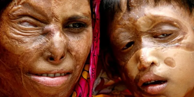 acid attack survivors