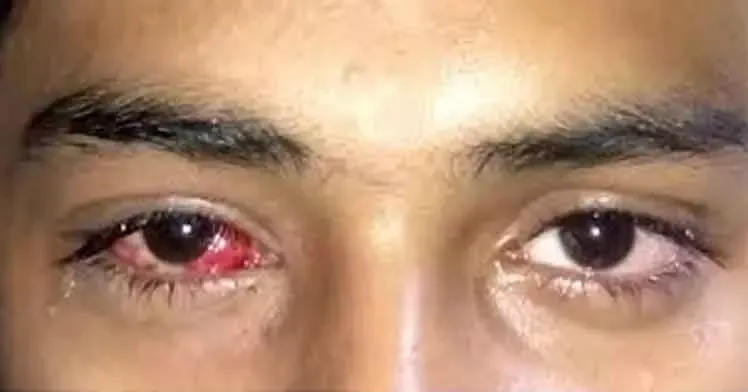 Madras eye