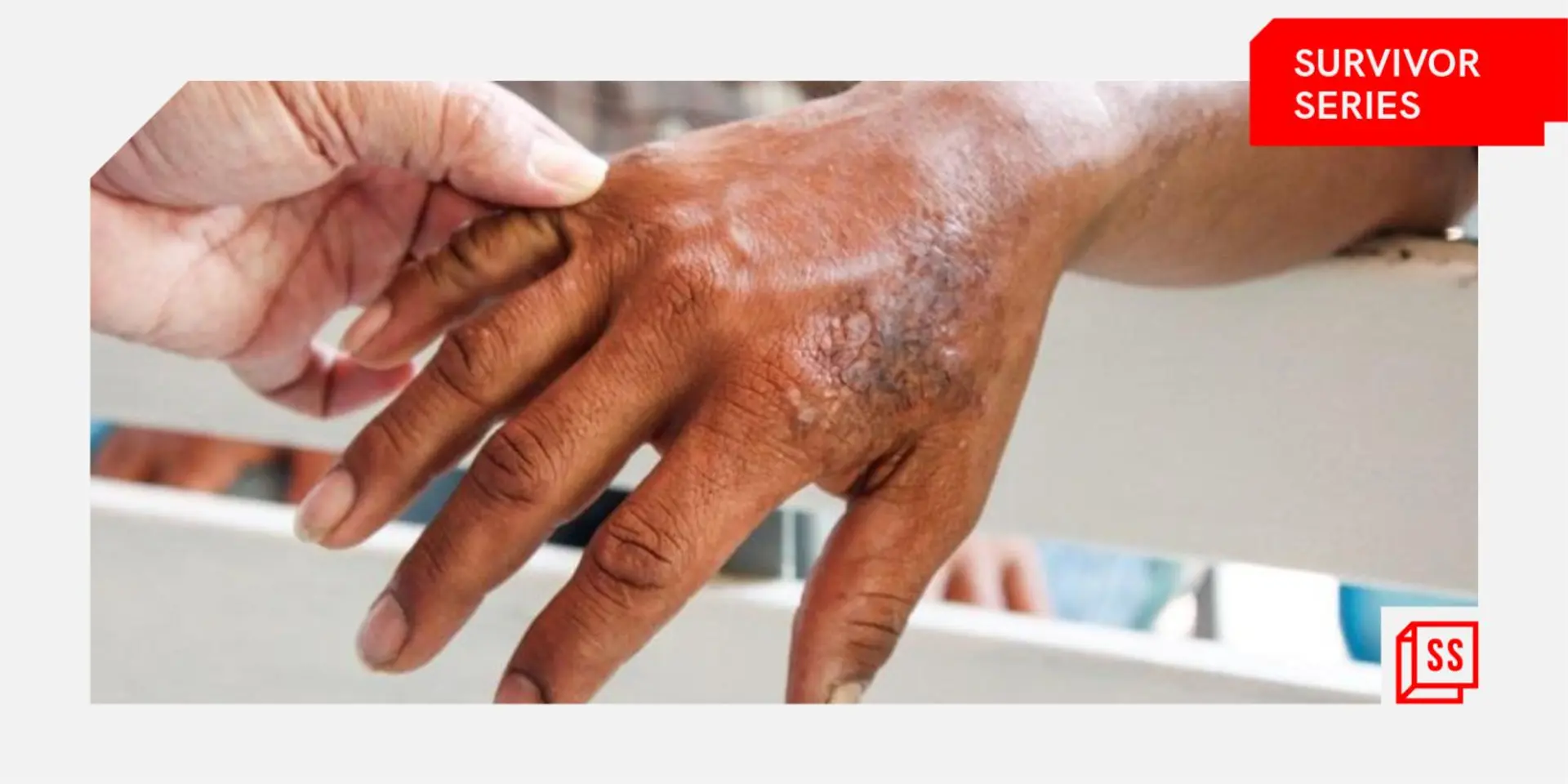 Survivor Series: I never got the respect I was looking for from the city due to leprosy