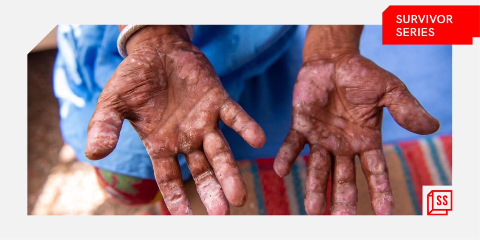 [Survivor Series] I cut off from people when I got leprosy because of shame