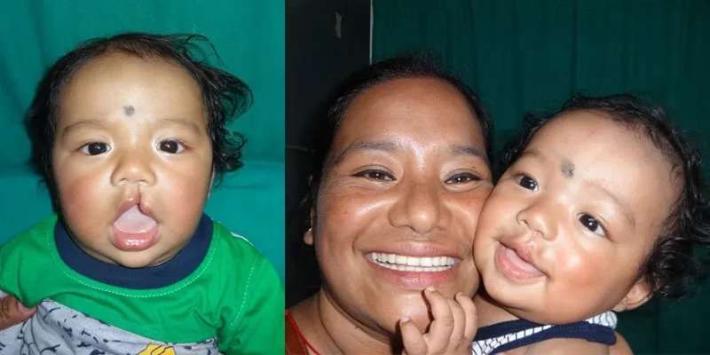 cleft, cleft lip, smile train