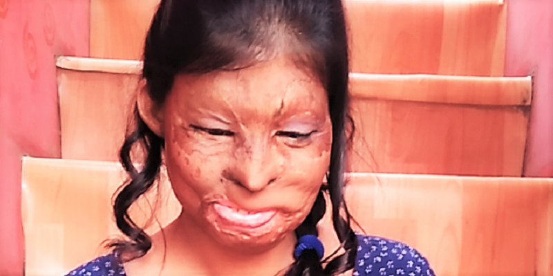From acid attack victim to running a boutique and a café – Rupa’s phenomenal story