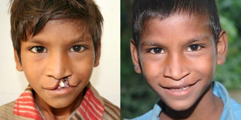 This Bengaluru-based organisation has given over 6,000 children with cleft lips their smile back
