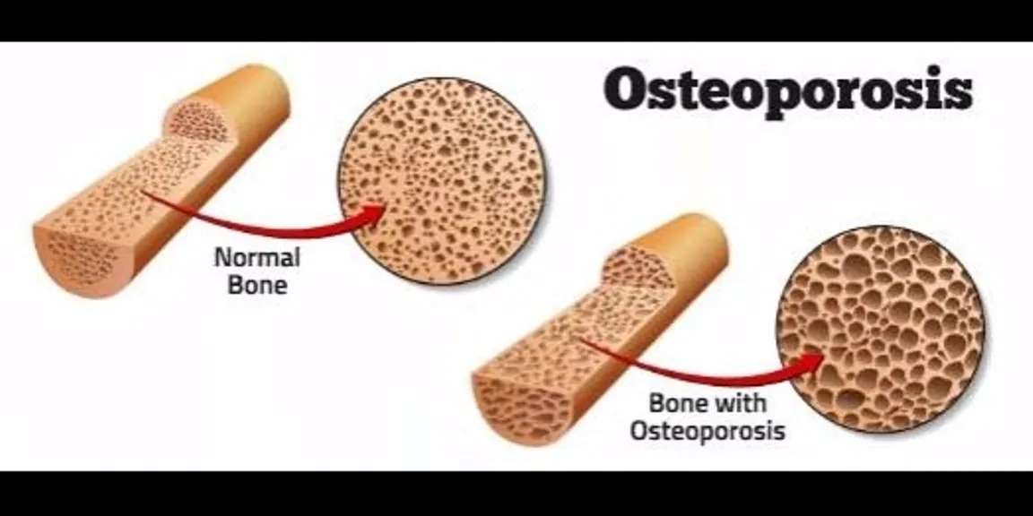 What is Osteoporosis? What can be done about it?