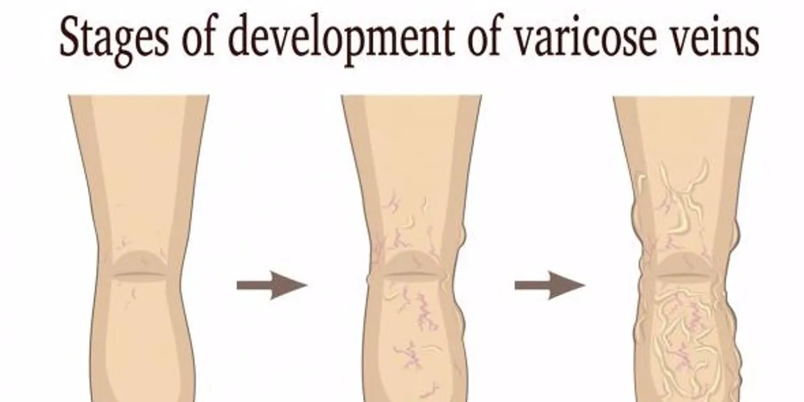 Why you should treat your varicose vein problem soon?