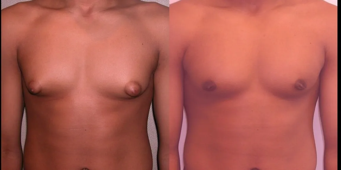 Effective and Safe Natural Male Breasts Reduction Treatment