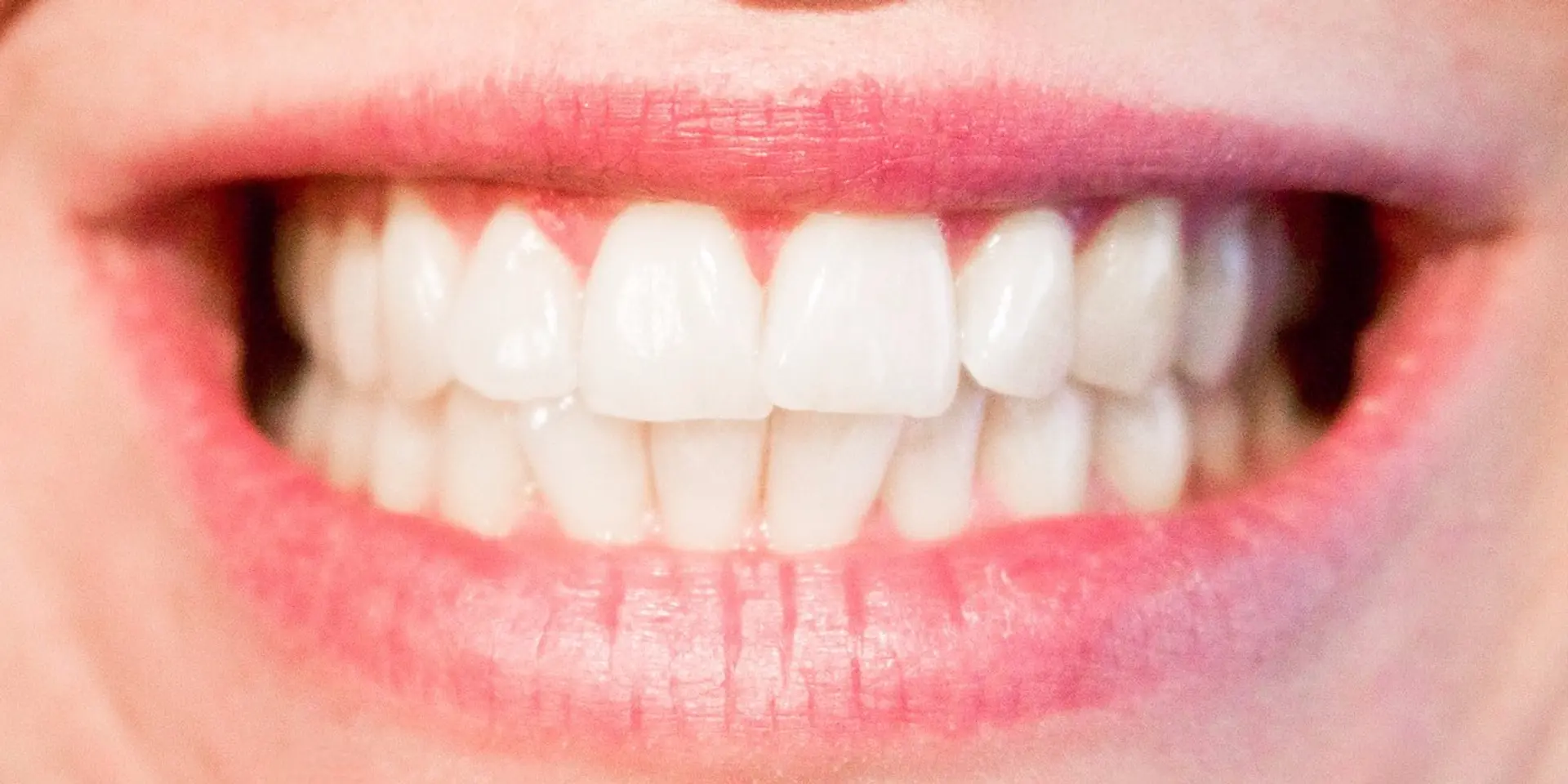 Restoring Your Smile After Complete Tooth Loss